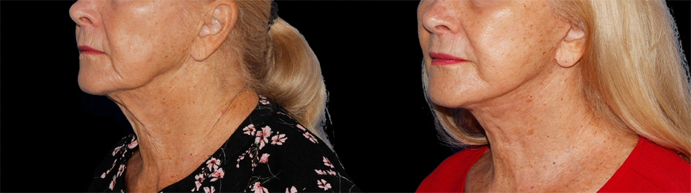 Before and After Photos Chevy Chase, MD Ikon Plastic Surgery and Medical Aesthetics Dr. James Economides