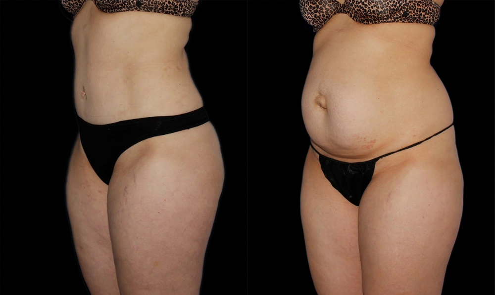 Before and After Photos Chevy Chase, MD Ikon Plastic Surgery and Medical Aesthetics Dr. James Economides