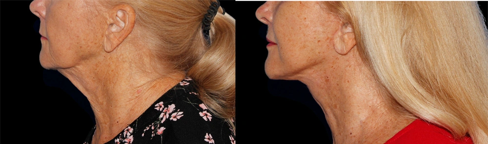 Before and After Photos Chevy Chase, MD Ikon Plastic Surgery and Medical Aesthetics Dr. James Economides