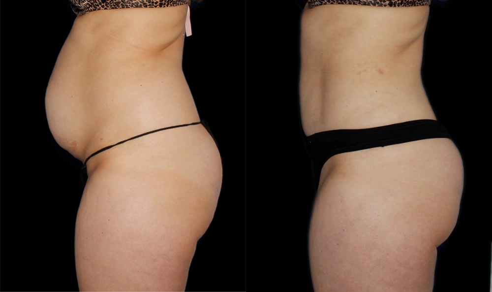 Before and After Photos Chevy Chase, MD Ikon Plastic Surgery and Medical Aesthetics Dr. James Economides