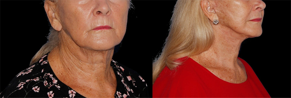 Before and After Photos Chevy Chase, MD Ikon Plastic Surgery and Medical Aesthetics Dr. James Economides