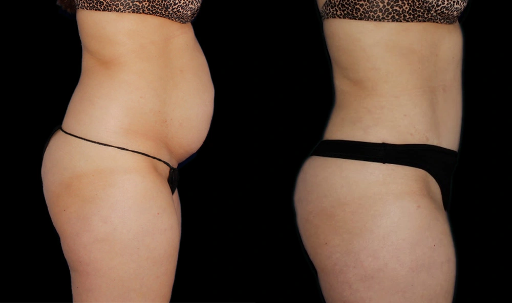 Before and After Photos Chevy Chase, MD Ikon Plastic Surgery and Medical Aesthetics Dr. James Economides