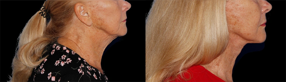 Before and After Photos Chevy Chase, MD Ikon Plastic Surgery and Medical Aesthetics Dr. James Economides