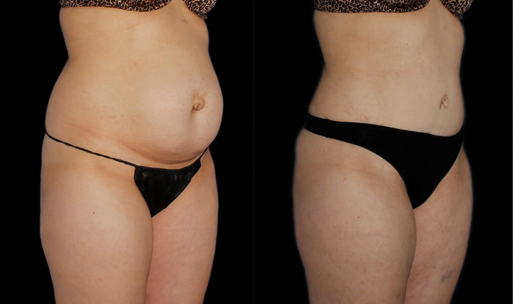 Before and After Photos Chevy Chase, MD Ikon Plastic Surgery and Medical Aesthetics Dr. James Economides
