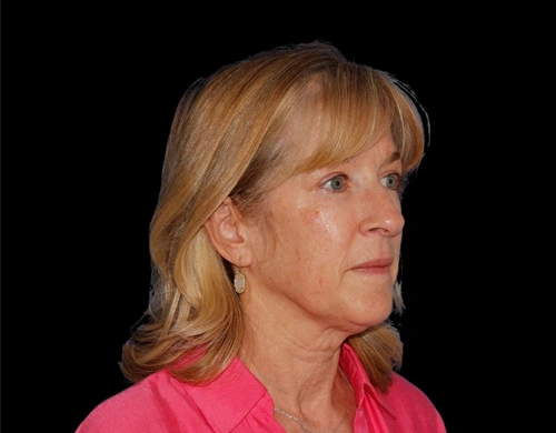 Before and After Photos Chevy Chase, MD Ikon Plastic Surgery and Medical Aesthetics Dr. James Economides