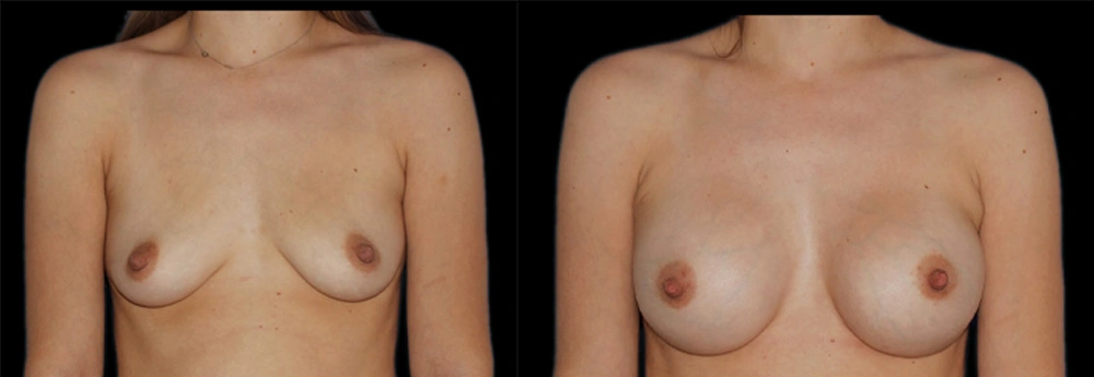 Before and After Photos Chevy Chase, MD Ikon Plastic Surgery and Medical Aesthetics Dr. James Economides
