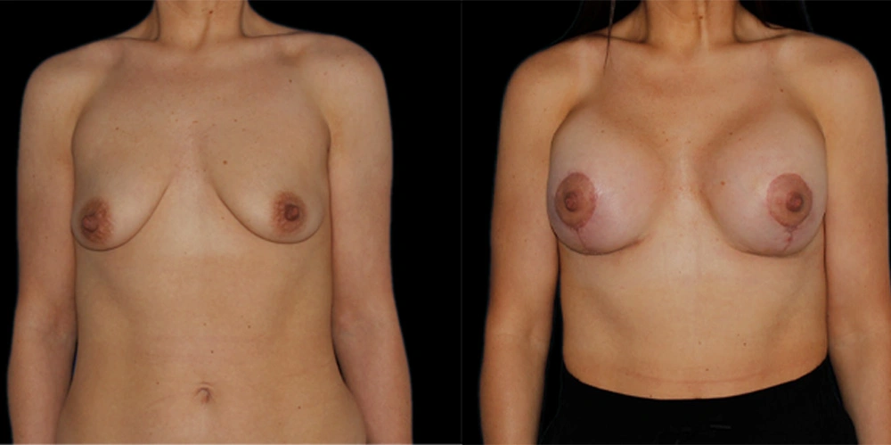 Before and After Photos Chevy Chase, MD Ikon Plastic Surgery and Medical Aesthetics Dr. James Economides