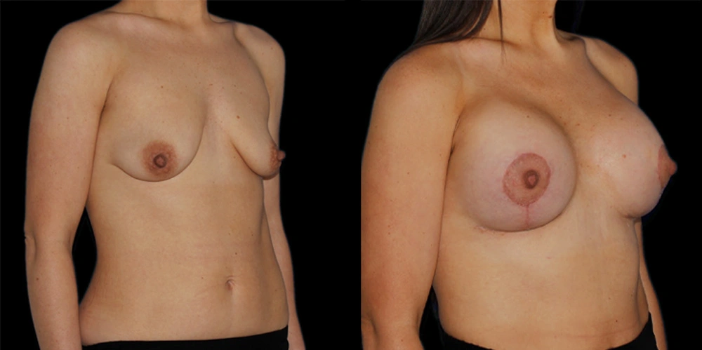 Before and After Photos Chevy Chase, MD Ikon Plastic Surgery and Medical Aesthetics Dr. James Economides