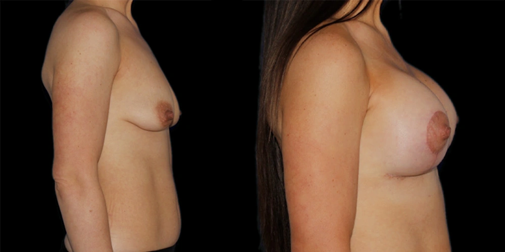 Before and After Photos Chevy Chase, MD Ikon Plastic Surgery and Medical Aesthetics Dr. James Economides