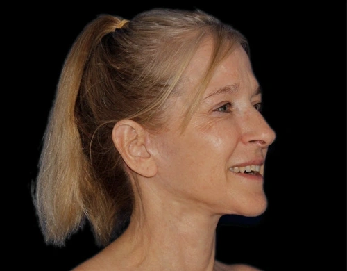 Before and After Photos Chevy Chase, MD Ikon Plastic Surgery and Medical Aesthetics Dr. James Economides