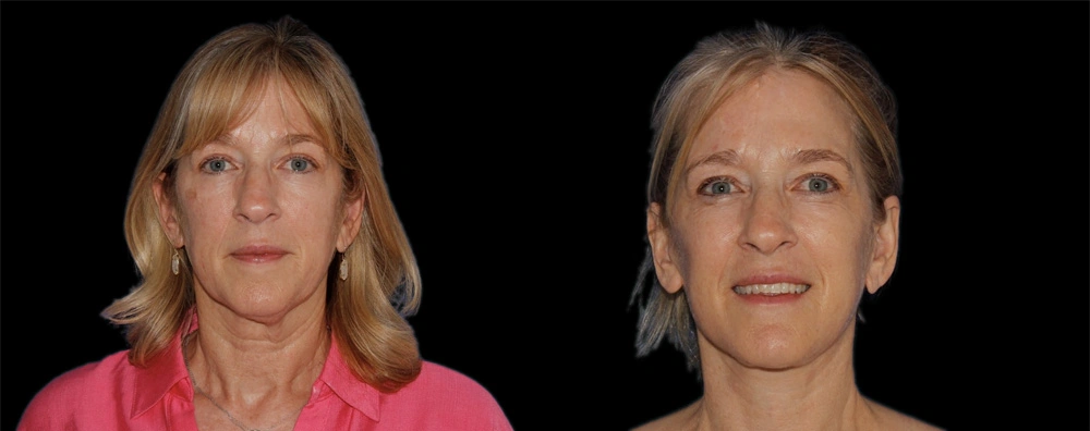 Before and After Photos Chevy Chase, MD Ikon Plastic Surgery and Medical Aesthetics Dr. James Economides