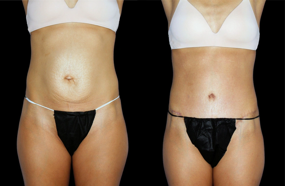 Before and After Photos Chevy Chase, MD Ikon Plastic Surgery and Medical Aesthetics Dr. James Economides