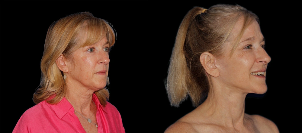Before and After Photos Chevy Chase, MD Ikon Plastic Surgery and Medical Aesthetics Dr. James Economides
