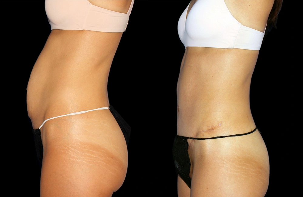 Before and After Photos Chevy Chase, MD Ikon Plastic Surgery and Medical Aesthetics Dr. James Economides