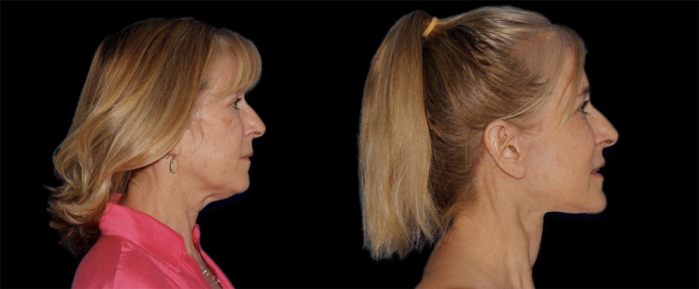Before and After Photos Chevy Chase, MD Ikon Plastic Surgery and Medical Aesthetics Dr. James Economides