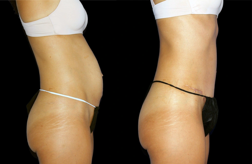Before and After Photos Chevy Chase, MD Ikon Plastic Surgery and Medical Aesthetics Dr. James Economides