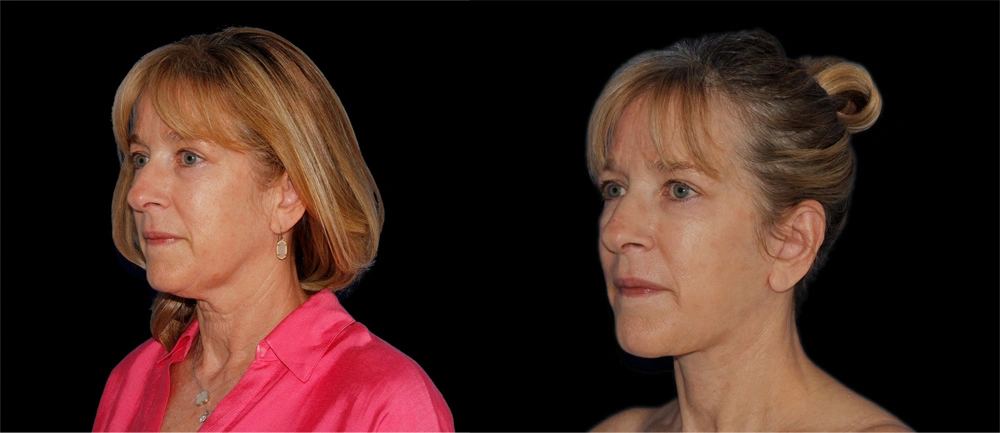 Before and After Photos Chevy Chase, MD Ikon Plastic Surgery and Medical Aesthetics Dr. James Economides