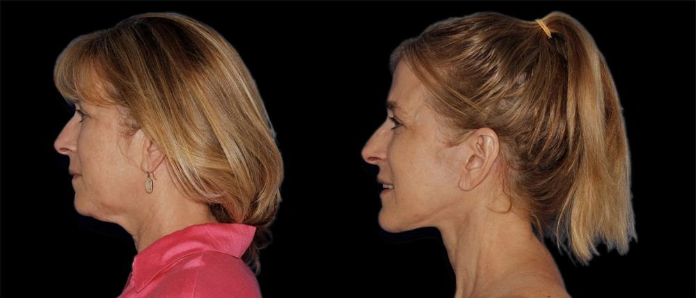 Before and After Photos Chevy Chase, MD Ikon Plastic Surgery and Medical Aesthetics Dr. James Economides