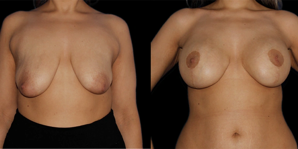Before and After Photos Chevy Chase, MD Ikon Plastic Surgery and Medical Aesthetics Dr. James Economides