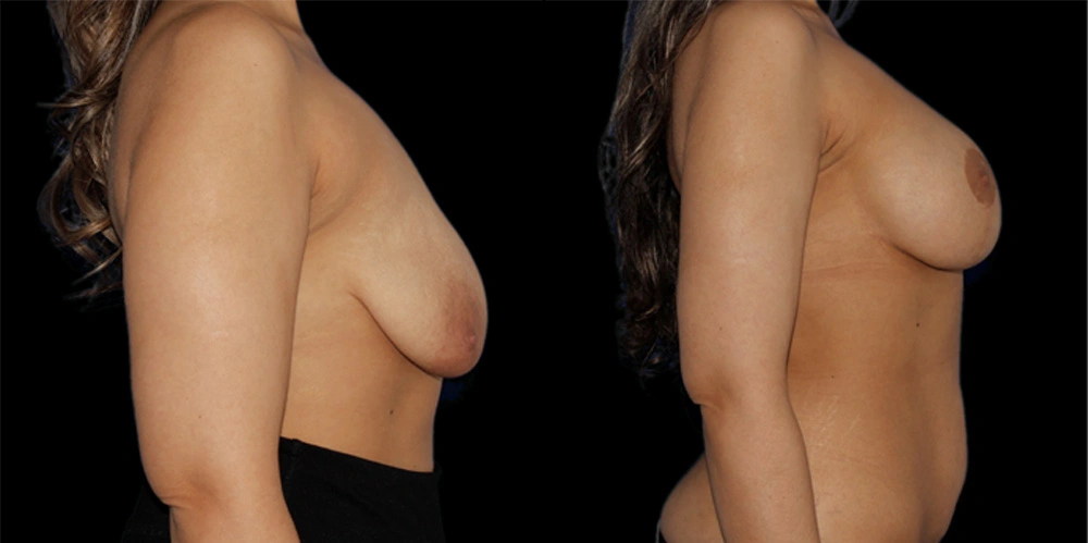 Before and After Photos Chevy Chase, MD Ikon Plastic Surgery and Medical Aesthetics Dr. James Economides