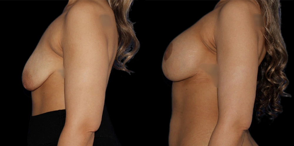 Before and After Photos Chevy Chase, MD Ikon Plastic Surgery and Medical Aesthetics Dr. James Economides