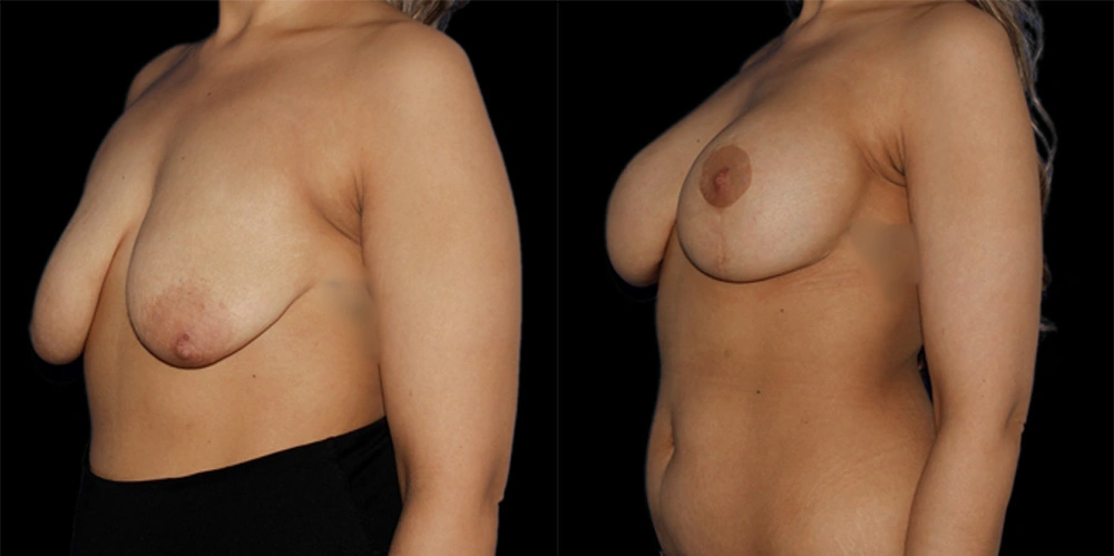 Before and After Photos Chevy Chase, MD Ikon Plastic Surgery and Medical Aesthetics Dr. James Economides