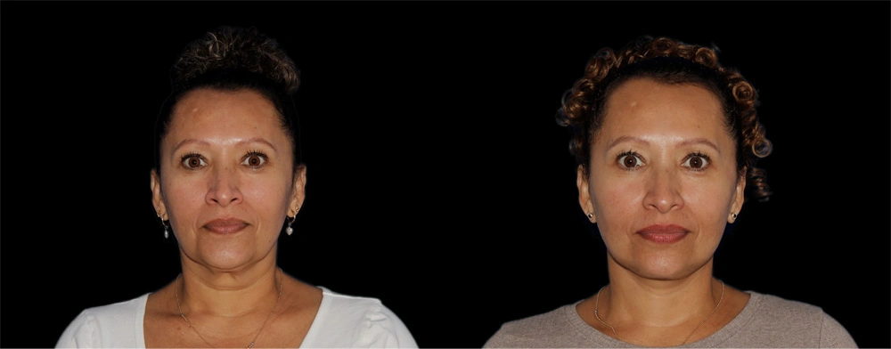 Before and After Photos Chevy Chase, MD Ikon Plastic Surgery and Medical Aesthetics Dr. James Economides