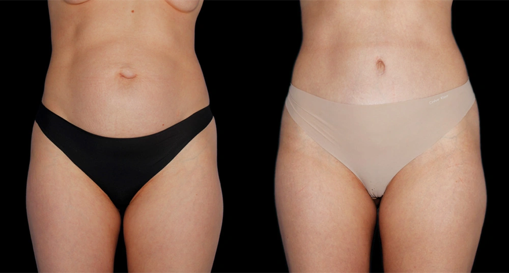 Before and After Photos Chevy Chase, MD Ikon Plastic Surgery and Medical Aesthetics Dr. James Economides