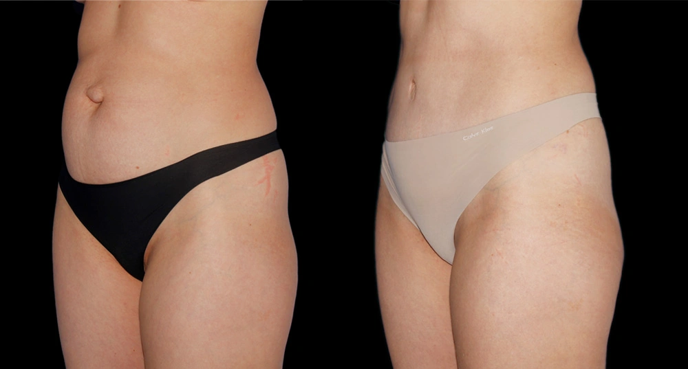 Before and After Photos Chevy Chase, MD Ikon Plastic Surgery and Medical Aesthetics Dr. James Economides