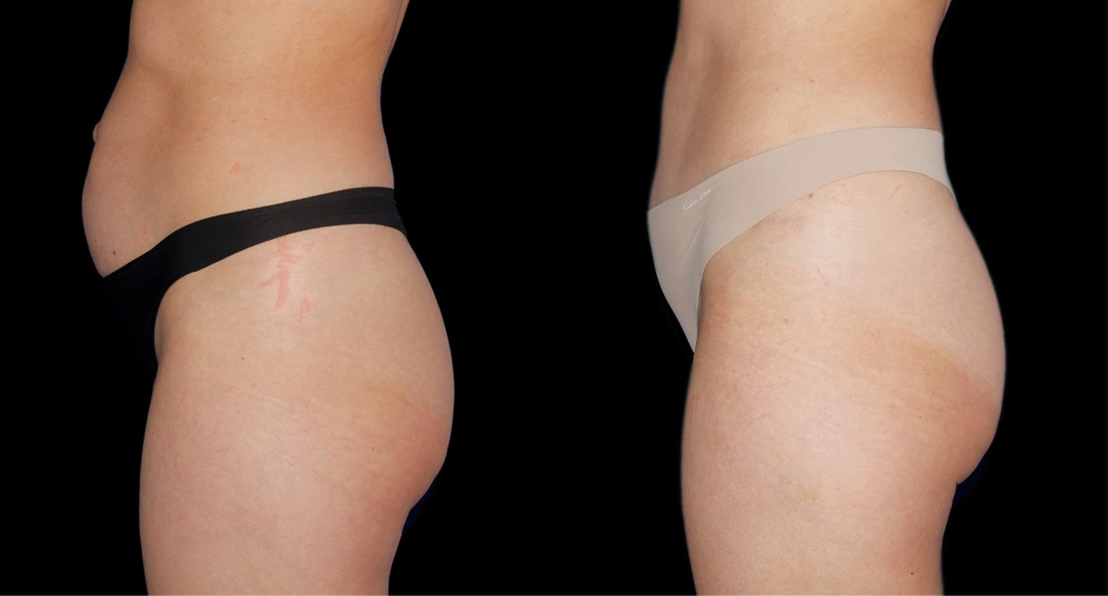 Before and After Photos Chevy Chase, MD Ikon Plastic Surgery and Medical Aesthetics Dr. James Economides