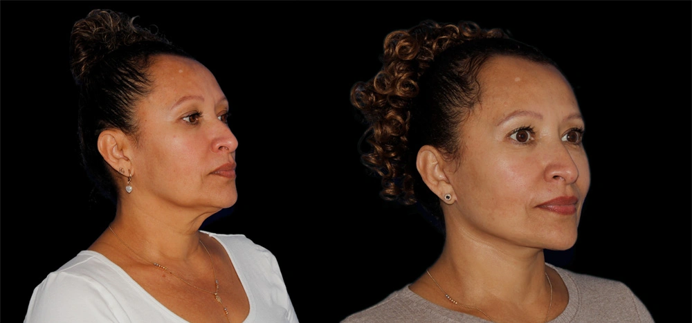 Before and After Photos Chevy Chase, MD Ikon Plastic Surgery and Medical Aesthetics Dr. James Economides