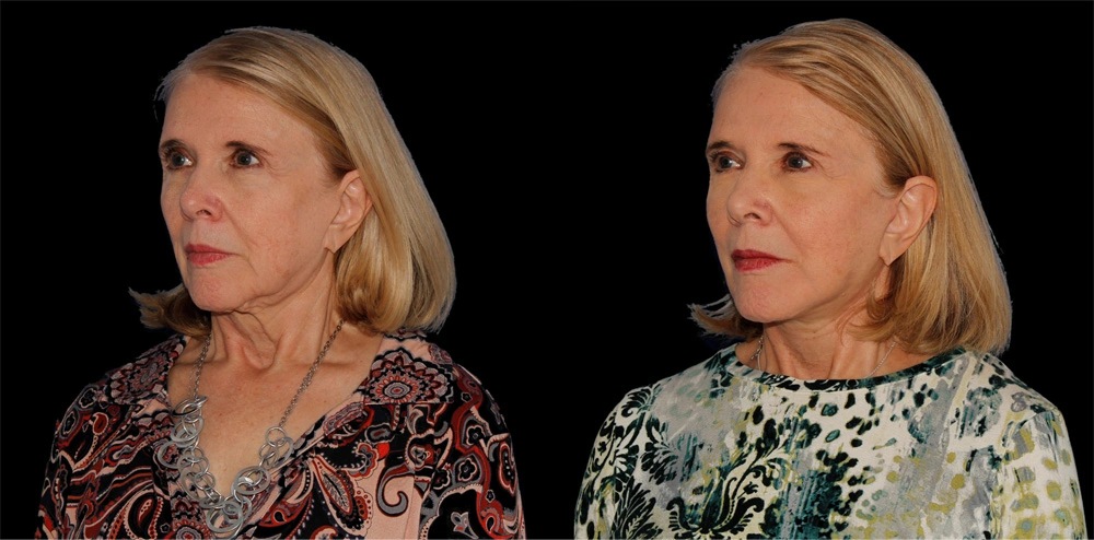 Before and After Photos Chevy Chase, MD Ikon Plastic Surgery and Medical Aesthetics Dr. James Economides