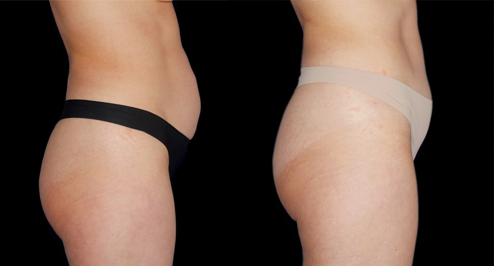 Before and After Photos Chevy Chase, MD Ikon Plastic Surgery and Medical Aesthetics Dr. James Economides