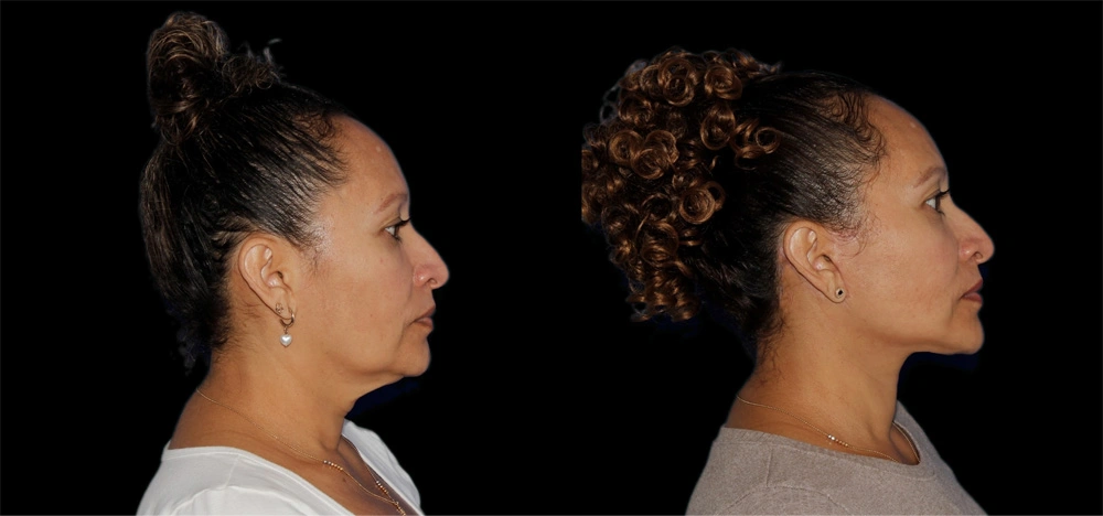 Before and After Photos Chevy Chase, MD Ikon Plastic Surgery and Medical Aesthetics Dr. James Economides