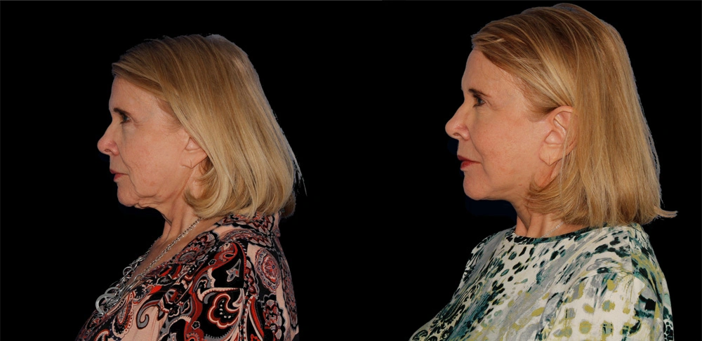 Before and After Photos Chevy Chase, MD Ikon Plastic Surgery and Medical Aesthetics Dr. James Economides