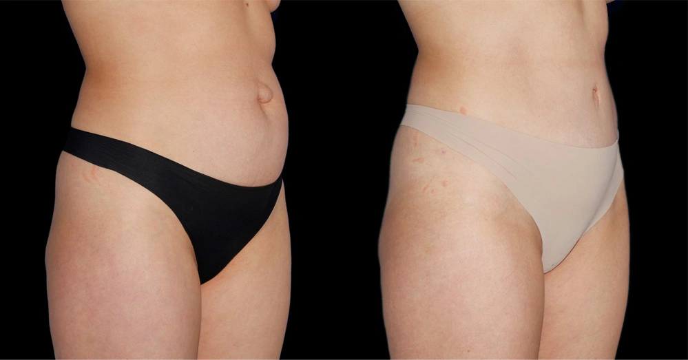 Before and After Photos Chevy Chase, MD Ikon Plastic Surgery and Medical Aesthetics Dr. James Economides