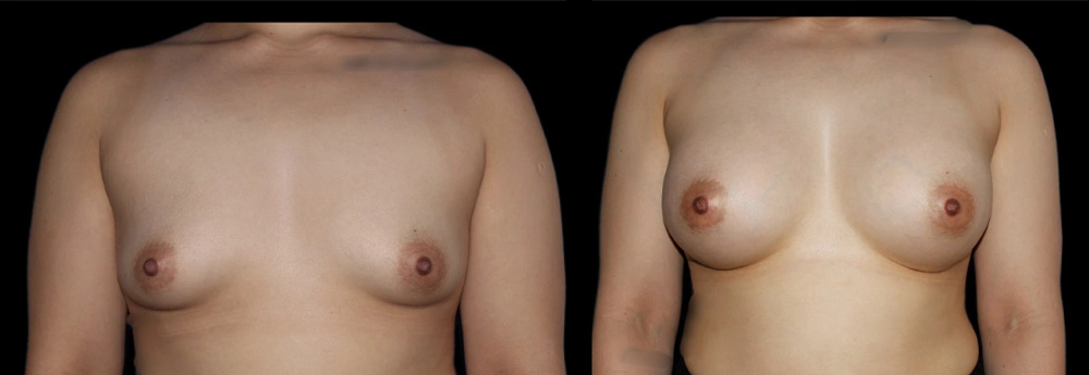 Before and After Photos Chevy Chase, MD Ikon Plastic Surgery and Medical Aesthetics Dr. James Economides