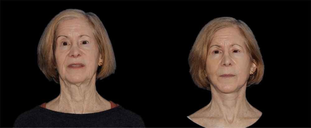 Before and After Photos Chevy Chase, MD Ikon Plastic Surgery and Medical Aesthetics Dr. James Economides