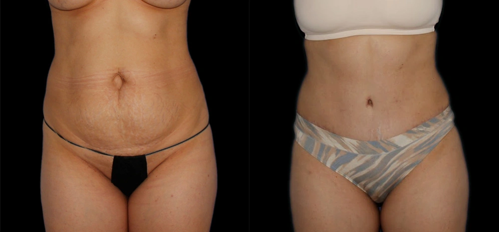 Before and After Photos Chevy Chase, MD Ikon Plastic Surgery and Medical Aesthetics Dr. James Economides