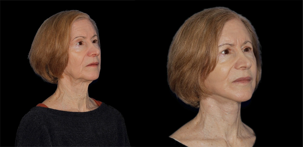 Before and After Photos Chevy Chase, MD Ikon Plastic Surgery and Medical Aesthetics Dr. James Economides