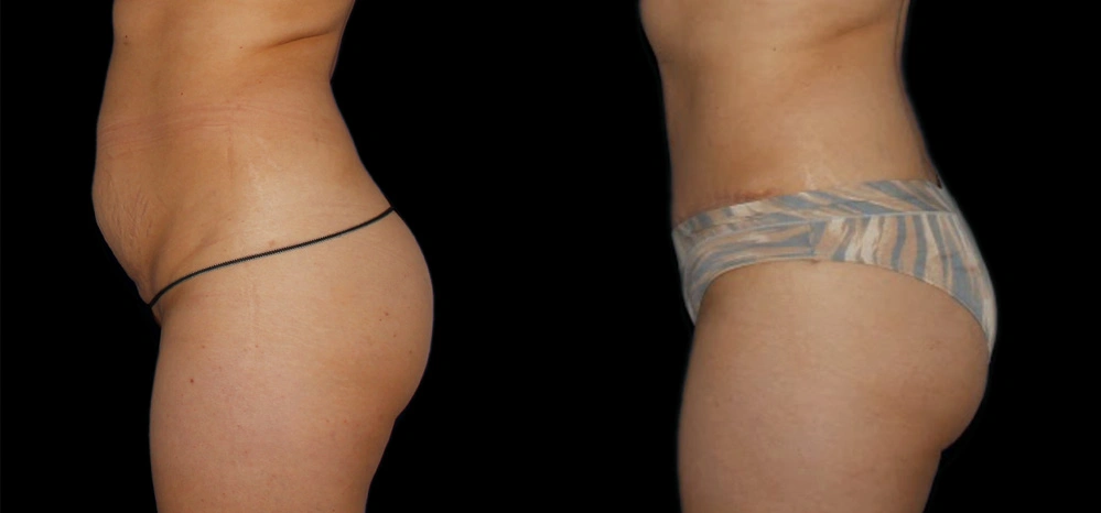 Before and After Photos Chevy Chase, MD Ikon Plastic Surgery and Medical Aesthetics Dr. James Economides