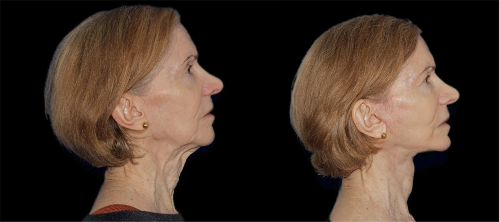 Before and After Photos Chevy Chase, MD Ikon Plastic Surgery and Medical Aesthetics Dr. James Economides
