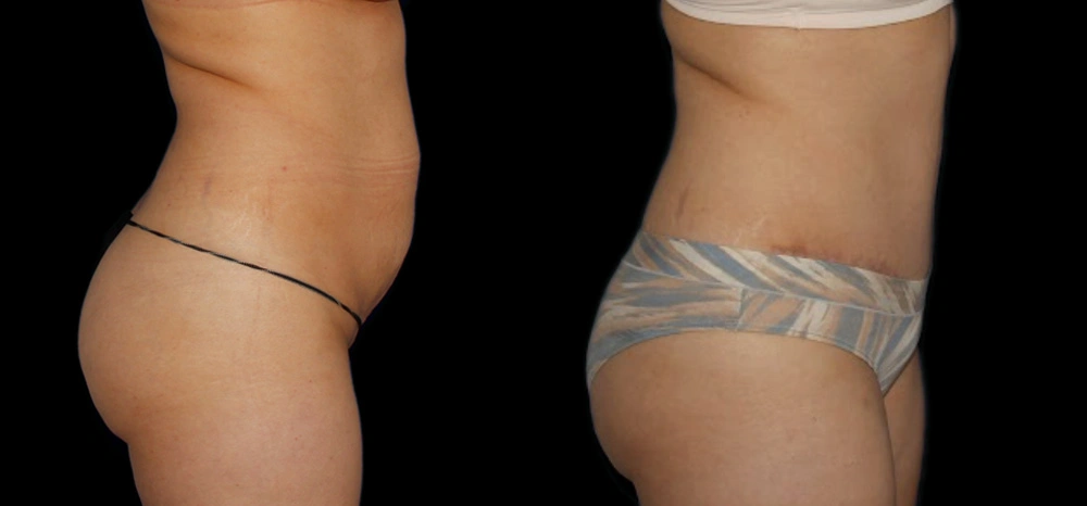 Before and After Photos Chevy Chase, MD Ikon Plastic Surgery and Medical Aesthetics Dr. James Economides