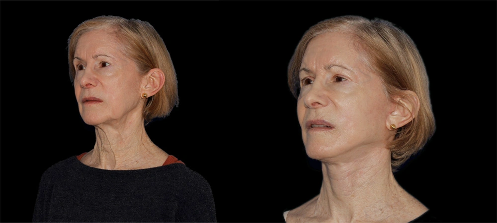 Before and After Photos Chevy Chase, MD Ikon Plastic Surgery and Medical Aesthetics Dr. James Economides
