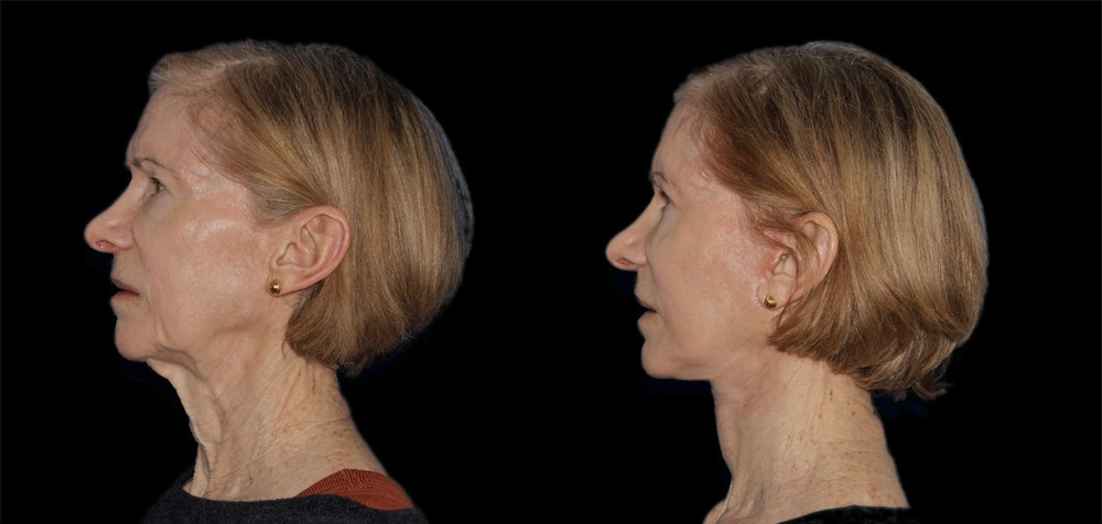 Before and After Photos Chevy Chase, MD Ikon Plastic Surgery and Medical Aesthetics Dr. James Economides