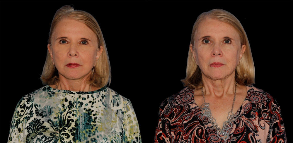 Before and After Photos Chevy Chase, MD Ikon Plastic Surgery and Medical Aesthetics Dr. James Economides