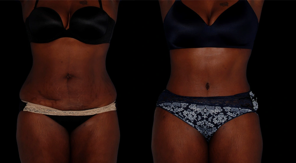 Before and After Photos Chevy Chase, MD Ikon Plastic Surgery and Medical Aesthetics Dr. James Economides