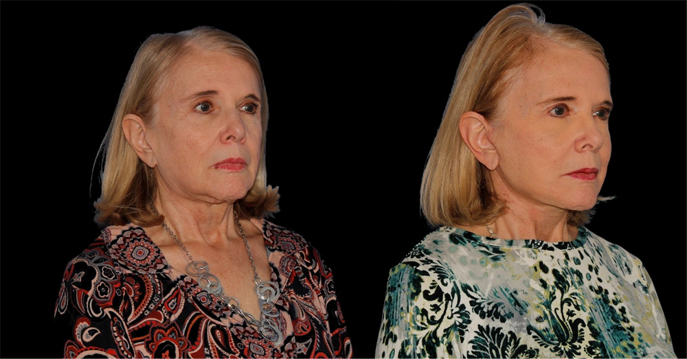 Before and After Photos Chevy Chase, MD Ikon Plastic Surgery and Medical Aesthetics Dr. James Economides