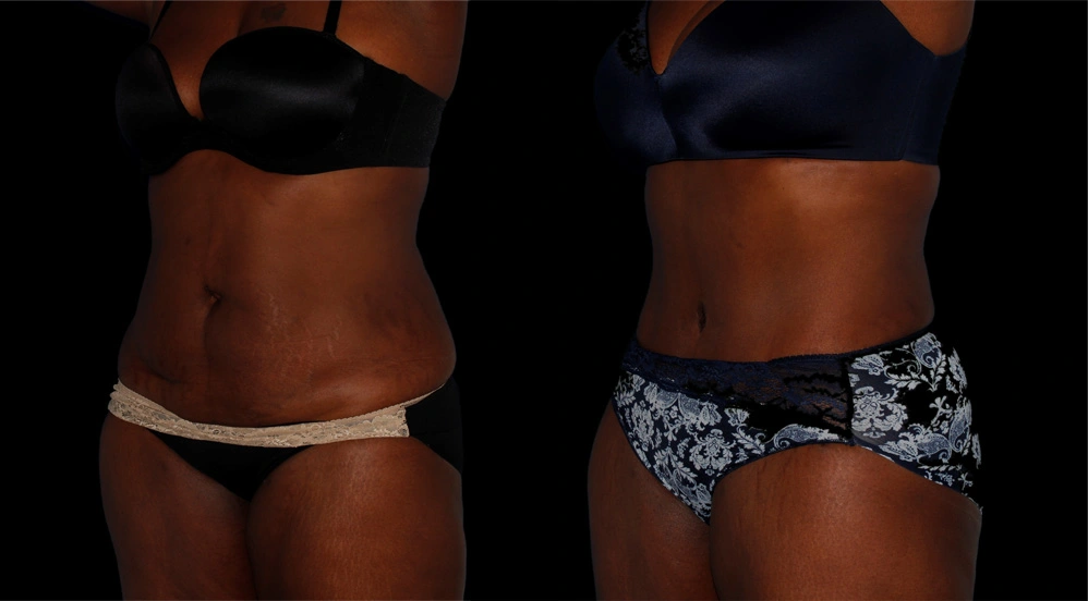Before and After Photos Chevy Chase, MD Ikon Plastic Surgery and Medical Aesthetics Dr. James Economides