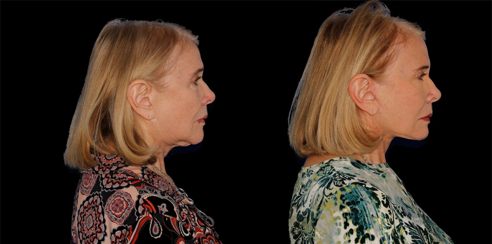 Before and After Photos Chevy Chase, MD Ikon Plastic Surgery and Medical Aesthetics Dr. James Economides